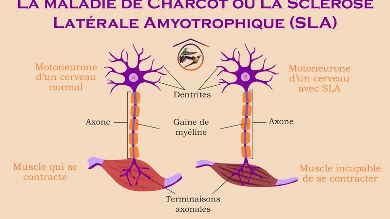 Illustration médicale liée à la maladie de Charcot